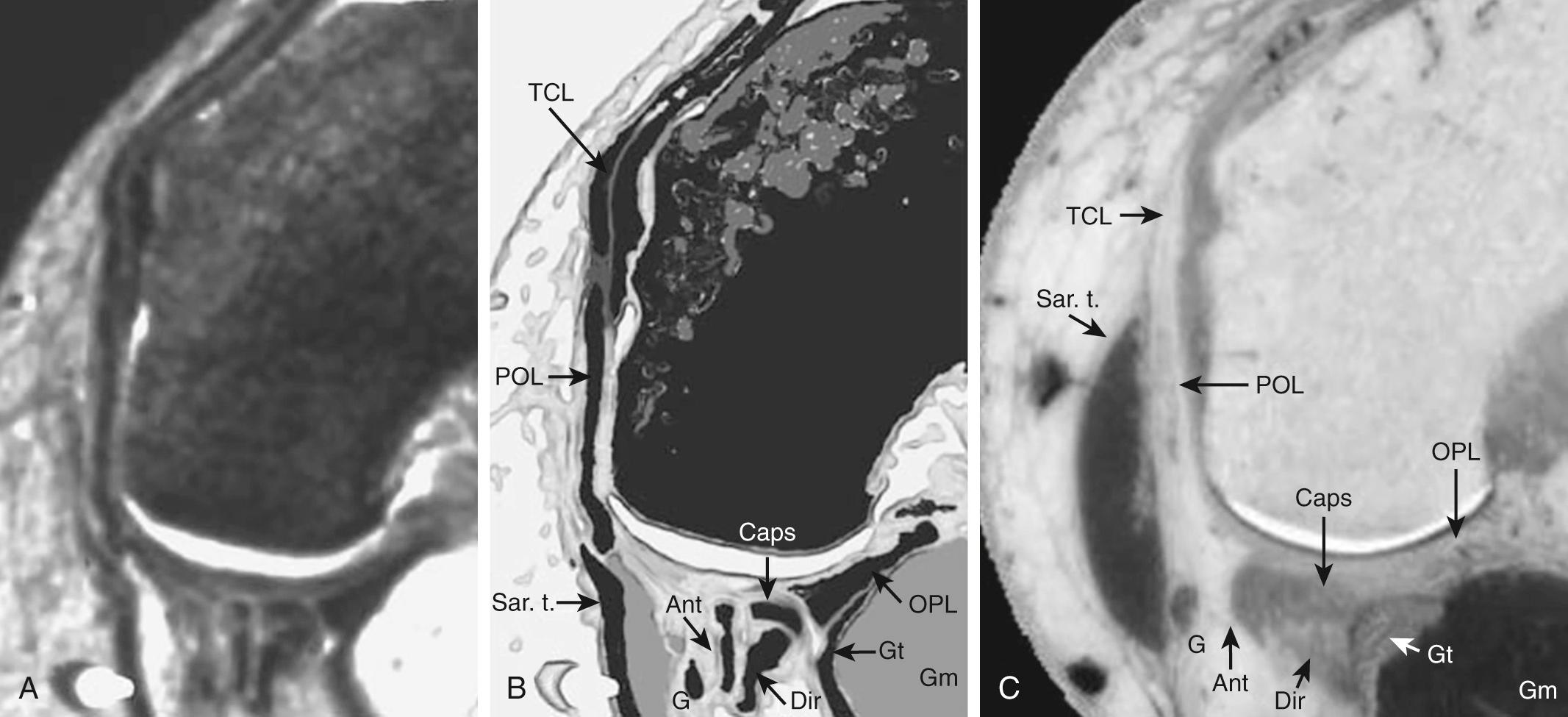 FIG 11.5, Semimembranosus Tendon Complex and Its Divisions/Arms and Their Relationships to Their Surrounding Structures at Various Levels Through the Knee: Level 2—Mid-Portion of the Femoral Condyles