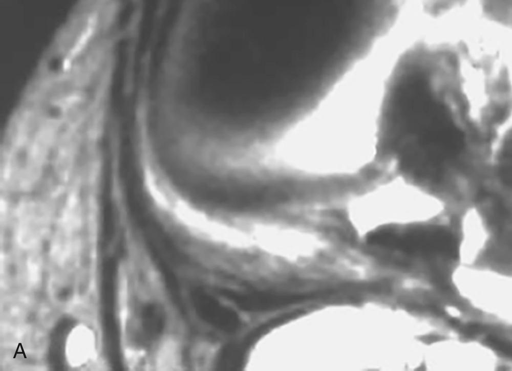 FIG 11.6, Semimembranosus Tendon Complex and Its Divisions/Arms and Their Relationships to Their Surrounding Structures at Various Levels Through the Knee: Level 3—Lower Portion of the Femoral Condyles