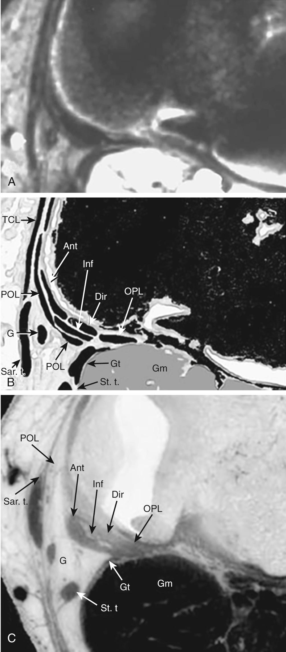 FIG 11.7, Semimembranosus Tendon Complex and Its Divisions/Arms and Their Relationships to Their Surrounding Structures at Various Levels Through the Knee: Level 4—Just Below the Joint Line