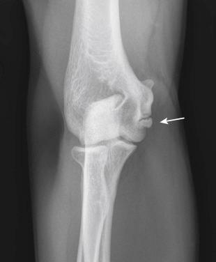 Fig. 26A.4, Anteroposterior radiograph of the elbow demonstrating ossification of the medial ulnar collateral ligament origin (arrow).