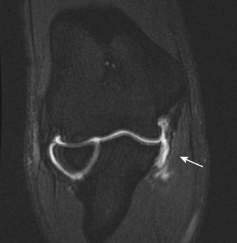 Fig. 26A.5, Magnetic resonance imaging arthrogram demonstrating medial ulnar collateral ligament discontinuity and dye extravasation (arrow) .