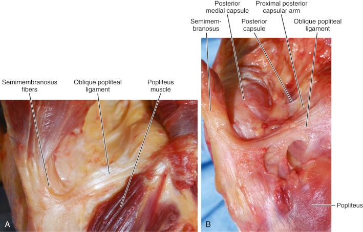 FIG 1-12, A, Semimembranosus fibers contributing to oblique popliteal ligament (OPL). B, OPL fans across the posterior knee with its multiple fibrous divisions. C, Posterior knee showing divisions of the POL.