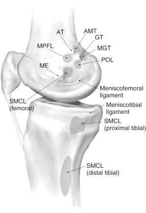 FIG 1-2, The femoral osseous landmarks and attachment sites of the main medial knee structures. AT, Adductor tubercle; AMT , adductor magnus tendon; GT , gastrocnemius tubercle; ME , medial epicondyle; MGT , medial gastrocnemius tendon; MPFL , medial patellofemoral ligament; POL , posterior oblique ligament; SMCL , superficial medial collateral ligament.