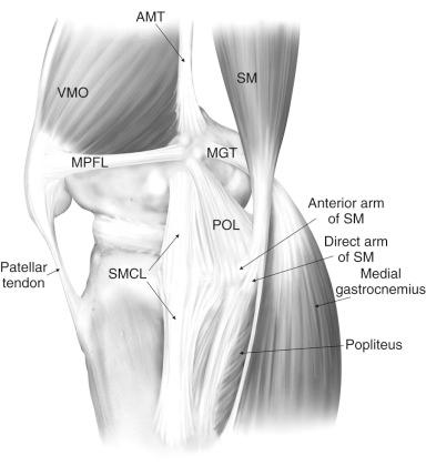 FIG 1-3, The main medial knee structures (right knee). AMT , Adductor magnus tendon; MGT , medial gastrocnemius tendon; SM , semimembranosus muscle; SMCL , superficial medial collateral ligament; MPFL , medial patellofemoral ligament; POL , posterior oblique ligament; VMO , vastus medialis obliquus.