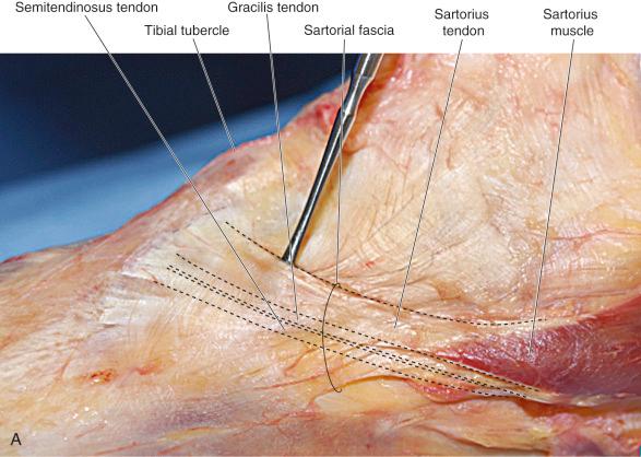 FIG 1-4, A, Sartorius fascia of layer 1 overlying the gracilis and semitendinosus tendons. B, Gracilis and semitendinosus tendons within pes anserine fascia. MCL, medial collateral ligament.