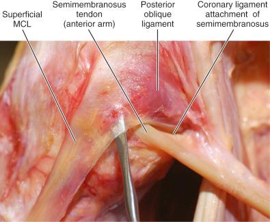 FIG 1-6, Oblique fibers of superficial medial collateral ligament (MCL) blending with the posterior oblique ligament. Note the coronary ligament attachment from the anterior arm of the semimembranosus.
