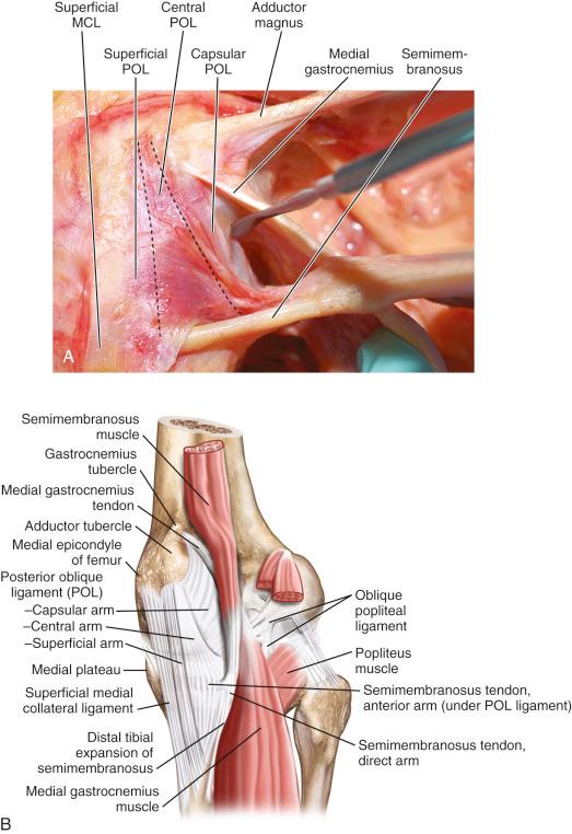 FIG 1-9, A, Insertions onto the medial femoral condyle of the adductor magnus, medial head of gastrocnemius, and posterior oblique ligament (POL) with its three divisions: capsular, central, and superficial arms. B, Anatomy of the POL with its three divisions. MCL, Medial collateral ligament.