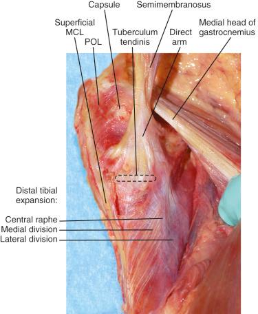 FIG 1-10, Distal tibial expansion of the semimembranosus tendon sheath with its medial and lateral divisions. MCL, Medial collateral ligament. POL, posterior oblique ligament.