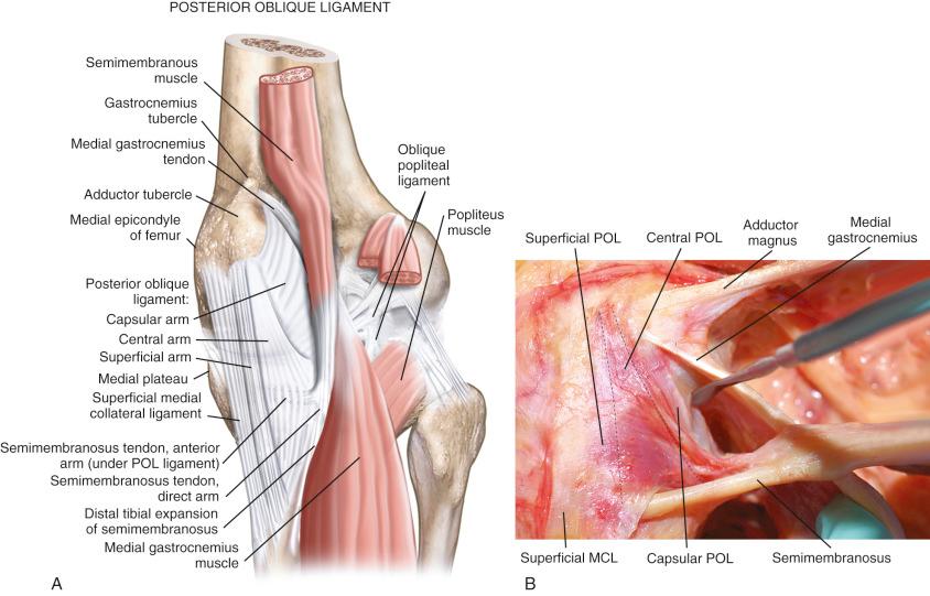 FIG 19-2, A and B, The anatomy of the medial and posteromedial aspect of the knee. The posteromedial capsule is shown divided into three functional regions, commonly designated as the posterior oblique ligament (POL). MCL , Medial collateral ligament.