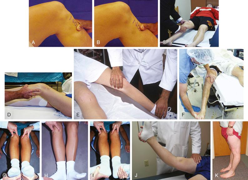 FIG 19-9, Demonstration of manual knee stability tests. A and B , Posterior drawer test at 90 degrees of knee flexion. C , Lachman test. D , Pivot shift test. E , Valgus test, palpating for medial joint opening at 30 and 0 degrees of flexion. F , Varus manual test, palpating for lateral joint opening, at 30 and 0 degrees of flexion. G to I , External rotation-internal rotation dial test. G , Starting position (performed at 30 and 90 degrees of flexion. H , Maximum at 30 degrees of flexion. I , Maximum at 90 degrees of flexion. J and K , Hyperextension and varus recurvatum tests supine and standing positions.