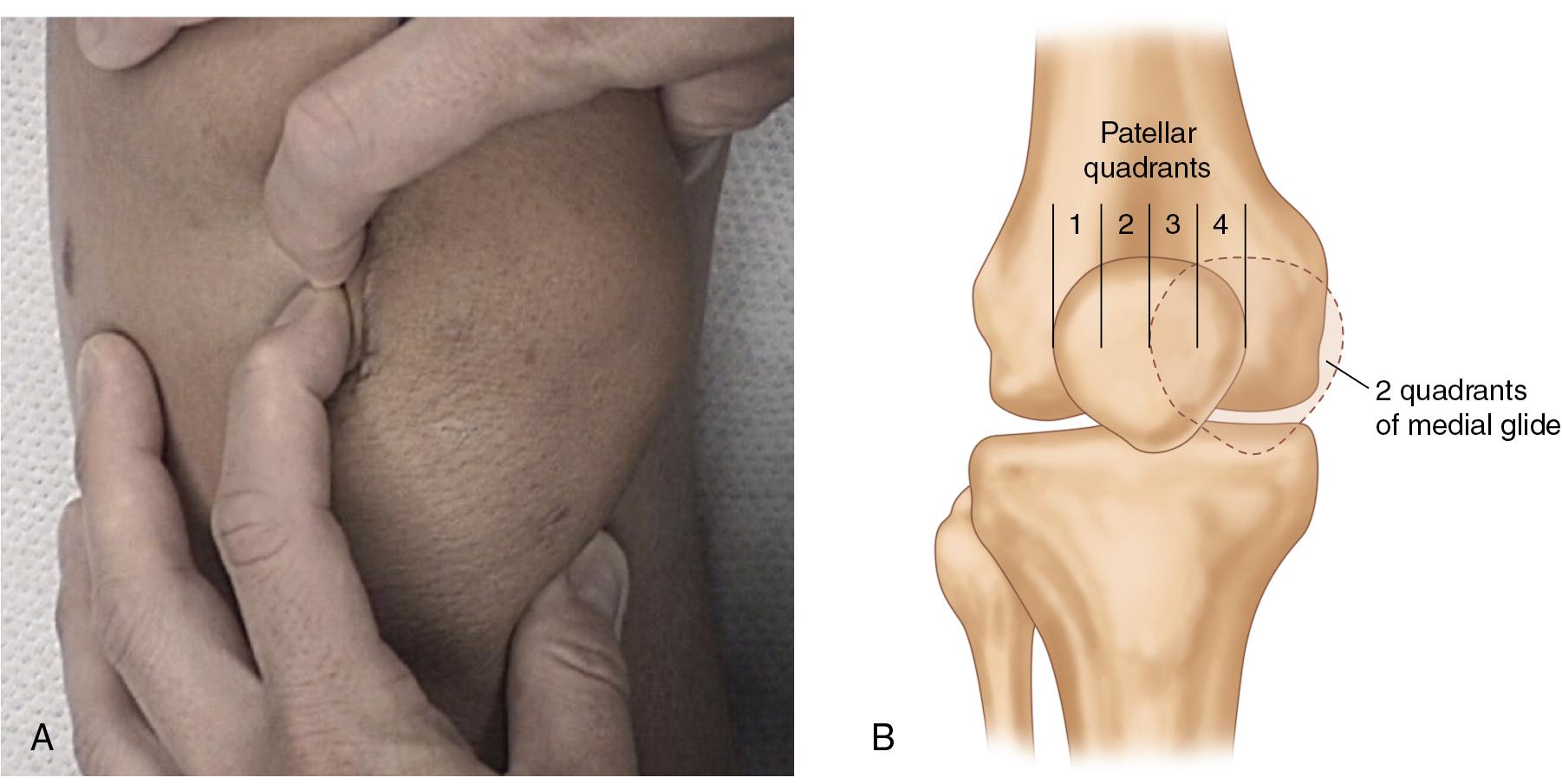 Fig. 100.1, (A) Assessing patients for patellar translation with direct pressure in the medial and lateral directions is crucial in the evaluation of patients in clinic, and while under anesthesia. (B) The translation of the patella is quantified based on the number of quadrants translated medial or lateral.
