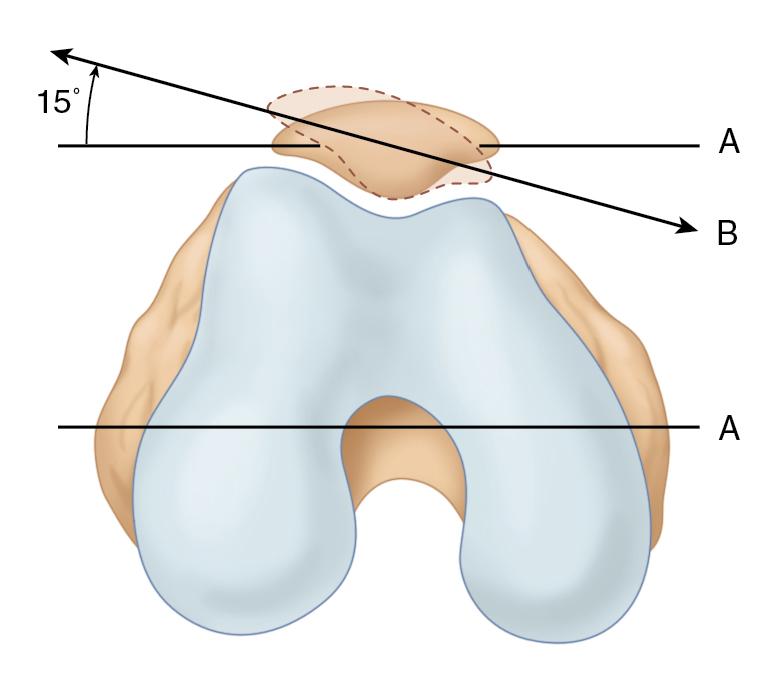 Fig. 100.2, The tilt test evaluates for the tightness of the lateral soft tissues, which are considered tight if the patella cannot be corrected to a neutral position.