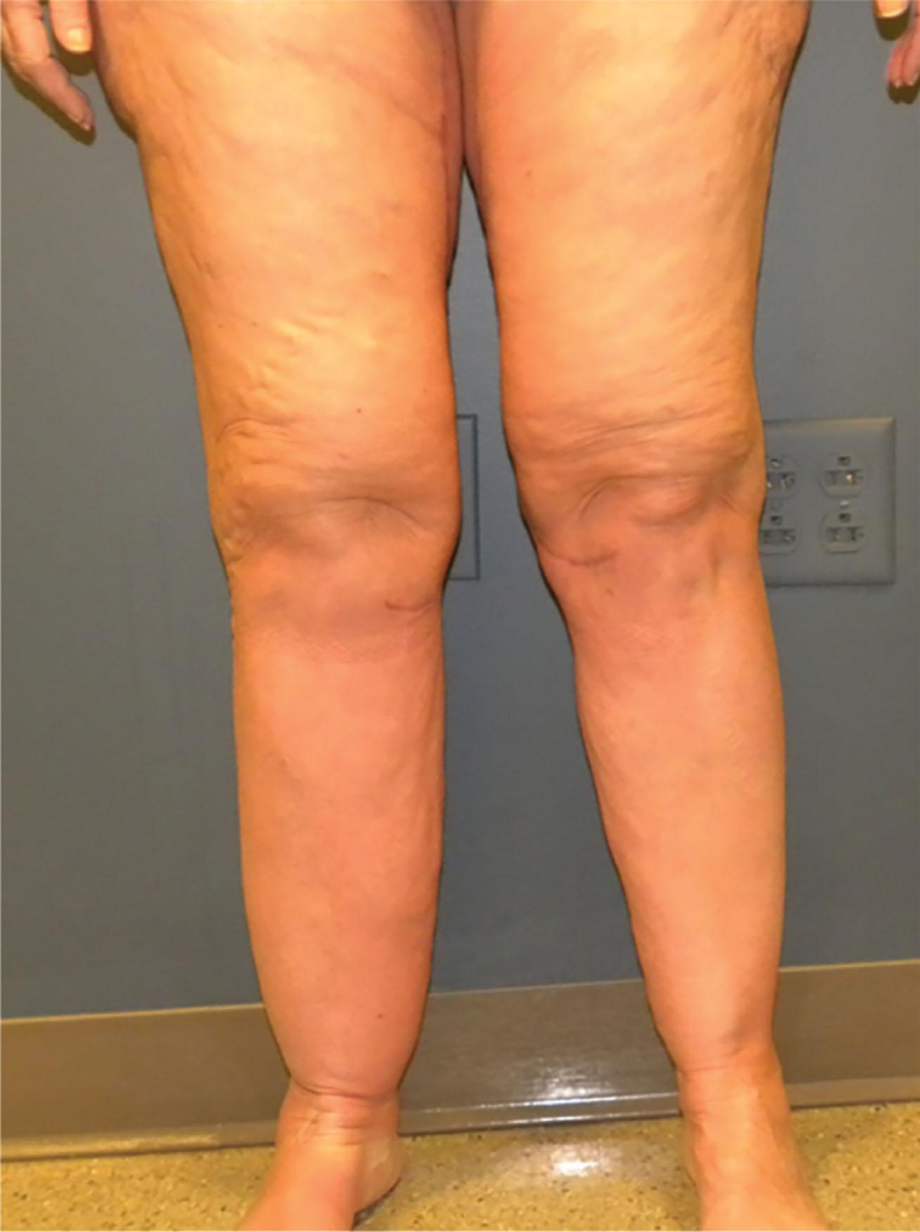 Figure 37.3, Sock sign and questionable postoperative edema vs. lipedema.