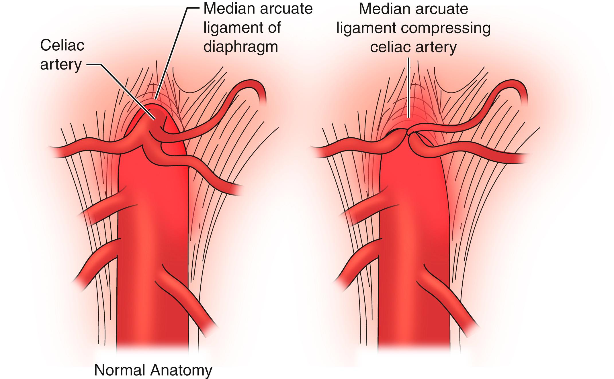 Figure 136.2, Artistic rendering of the proposed pathophysiology of celiac artery compression in those patients with median arcuate ligament syndrome.