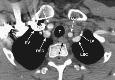 FIG 38-1, Axial plane—thoracic inlet level. The trachea (T) and esophagus (E) are midline and separate the right and left vascular structures. LCC, left common carotid artery; LSC, left subclavian artery; LV, left brachiocephalic vein; RCC, right common carotid artery; RSC, right subclavian artery; RV, right brachiocephalic vein.