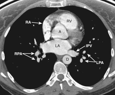 FIG 38-11, Axial plane—left atrial level. A, aortic root; D, descending aorta; IPV, left inferior pulmonary vein; LA, left atrium; LPA, left lower lobe pulmonary arteries; RA, right atrium; RPA, right lower lobe pulmonary artery; RV, right ventricle.
