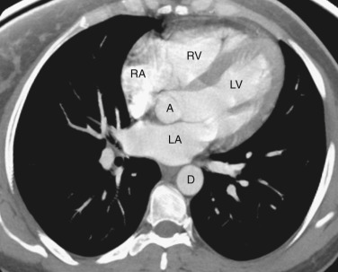 FIG 38-12, Axial plane—four-chamber level. A, aortic root; D, descending aorta; LA, left atrium; LV, left ventricle; RA, right atrium; RV, right ventricle.