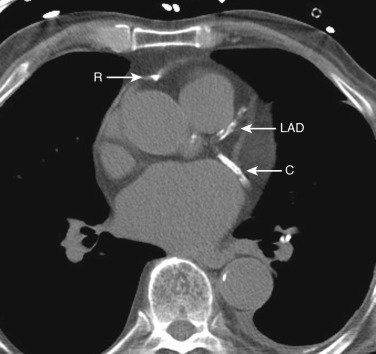 FIG 38-13, Axial plane—calcified coronary arteries at the four-chamber level. C, circumflex coronary artery; LAD, left anterior descending coronary artery; R, right coronary artery.