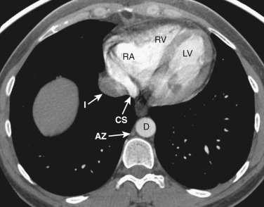 FIG 38-14, Axial plane—three-chamber level. The left atrium is more cranial to this level and not visible. The three visualized chambers are the right atrium (RA), right ventricle (RV), and left ventricle (LV). The coronary sinus (CS) is between the inferior vena cava (I) and the left ventricle. AZ, azygos vein; D, descending aorta.