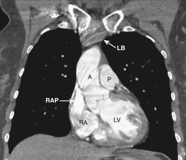 FIG 38-15, Coronal plane—aortic outflow tract level. A, aorta; LB, left brachiocephalic vein; LV, left ventricle; P, pulmonary artery; RA, right atrium; RAP, right atrial appendage.