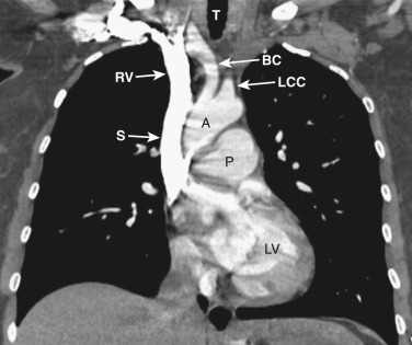 FIG 38-16, Coronal plane—ascending aorta level. A, aorta; BC, brachiocephalic artery; LCC, left common carotid artery; LV, left ventricle; P, pulmonary artery; RV, right brachiocephalic vein; S, superior vena cava; T, trachea.