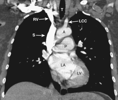 FIG 38-17, Coronal plane—pulmonary artery level. A, aorta; LA, left atrium; LCC, left common carotid artery; LV, left ventricle; P, pulmonary artery; RV, right brachiocephalic vein; S, superior vena cava; T, trachea.
