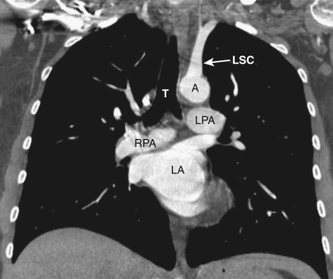 FIG 38-18, Coronal plane—left atrial level. A, aorta; LA, left atrium; LPA, left pulmonary artery; LSC, left subclavian artery; RPA, right pulmonary artery; T, trachea.