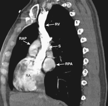 FIG 38-20, Sagittal plane—superior vena cava level. RA, right atrium; RAP, right atrial appendage; RPA, right pulmonary artery; RV, right brachiocephalic vein; S, superior vena cava.