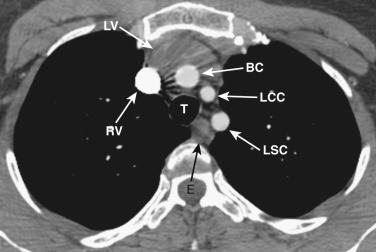 FIG 38-2, Axial plane—left brachiocephalic vein level. The right (RV) and left (LV) brachiocephalic veins are anterior to the right brachiocephalic artery (BC), left common carotid artery (LCC), left subclavian artery (LSC), trachea (T), and esophagus (E).