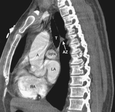 FIG 38-21, Sagittal plane—right atrial level. A, ascending aorta; AZ, azygos vein; LA, left atrium; RA, right atrium; RPA, right pulmonary artery; T, trachea.