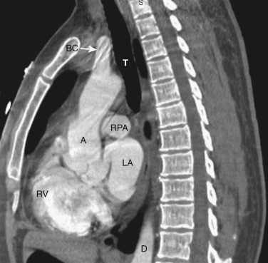 FIG 38-22, Sagittal plane—aortic outflow tract level. A, ascending aorta; BC, brachiocephalic artery; D, descending aorta; LA, left atrium; RPA, right pulmonary artery; RV, right ventricle; T, trachea.
