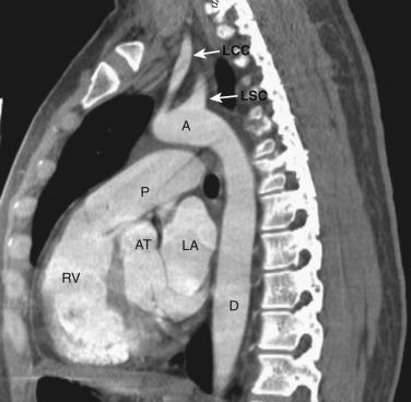 FIG 38-23, Sagittal plane—pulmonary artery outflow tract level. A, ascending aorta; AT, aortic outflow tract; D, descending aorta; LA, left atrium; LCC, left common carotid artery; LSC, left subclavian artery; P, pulmonary artery (outflow tract); RV, right ventricle.