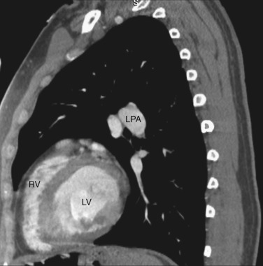 FIG 38-24, Sagittal plane—left ventricular level. LPA, left pulmonary artery; LV, left ventricle; RV, right ventricle.