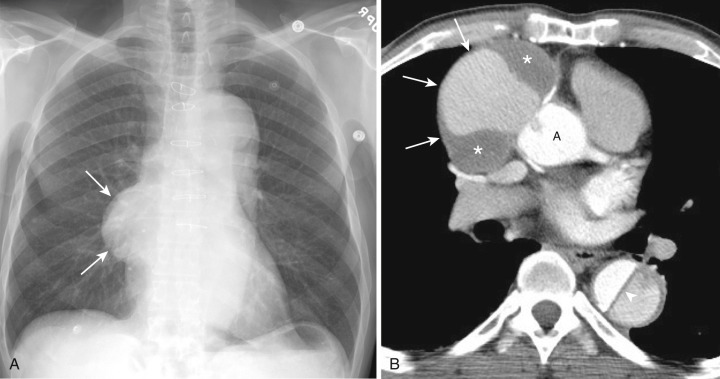 FIG 38-25, Coronary artery pseudoaneurysm post ascending aortic repair. A, Posteroanterior chest radiograph shows a mediastinal mass (arrows) superimposed on the right heart border and hilum. B, Contrast-enhanced CT demonstrates the mass to represent a large pseudoaneurysm (arrows) with marginal thrombus (asterisks) arising from the right coronary artery anastomosis with the ascending aortic graft (A). Descending aortic dissection (arrowhead) is also present. A, ascending aortic graft.