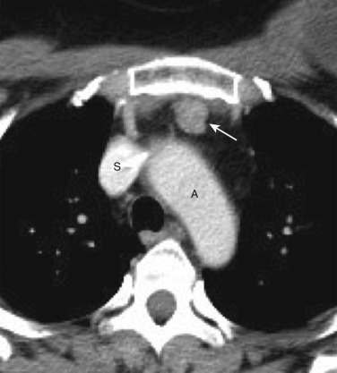 FIG 38-26, Thymoma in a woman with myasthenia gravis. The chest radiograph (not shown) was normal. Because of the association between myasthenia gravis and thymoma, contrast-enhanced chest CT was performed, revealing a small soft tissue mass in the anterior mediastinum (arrow). Resection confirmed thymoma. A, aorta; S, superior vena cava.