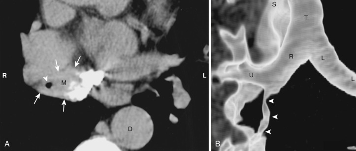 FIG 38-27, Fibrosing mediastinitis. A, Axial CT shows marked narrowing of the bronchus intermedius (arrowhead) by a soft tissue attenuation mass (M, arrows ). Note the extensive subcarinal calcification. B, Volume-rendered shaded-surface display shows long-segment irregular narrowing of the bronchus intermedius (arrowheads). 3D reconstructions can facilitate assessment and treatment of airway stenoses. D, descending aorta; L, left main bronchus; R, right main bronchus; S, superior vena cava; T, trachea; U, right upper lobe bronchus.