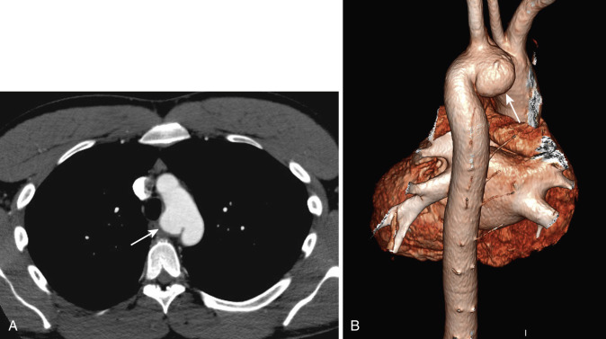 FIG 38-28, Traumatic aortic pseudoaneurysm. A, Axial contrast-enhanced CT demonstrates a focal contour abnormality of the medial aortic arch (arrow). B, Volume surface-rendered reconstruction in a posterior coronal plane better demonstrates the three-dimensional nature of the pseudoaneurysm (arrow) and its relationship to other anatomic structures. 3D reconstructions of CT angiograms display anatomy in a more familiar perspective to clinicians than do axial CT images.