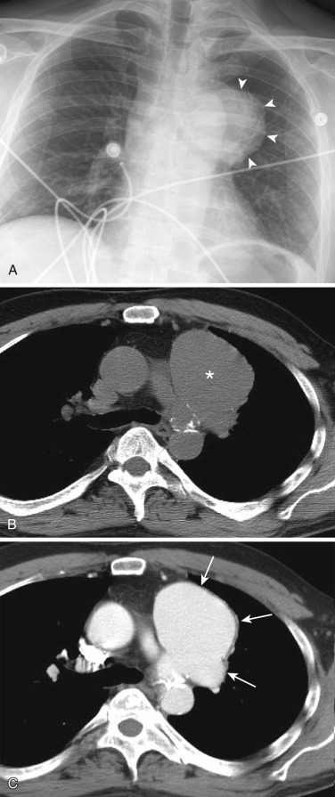 FIG 38-29, Pseudoaneurysm of the proximal descending aorta. A, Posteroanterior chest radiograph shows a soft tissue mass (arrowheads) superimposed on the left hemithorax, with preserved arch and descending aortic interfaces. B, Noncontrast chest CT was performed, revealing a homogeneous mass (asterisk) of the middle and anterior mediastina. Percutaneous biopsy was requested by the primary care team for tissue diagnosis. C, In lieu of biopsy, a contrast-enhanced CT was performed, revealing the mass to represent a large pseudoaneurysm (arrows) arising at the isthmus of the proximal descending thoracic aorta.