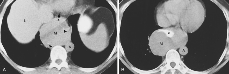 FIG 38-30, Esophageal leiomyoma. A, CT shows a large middle mediastinal mass with focal punctate calcifications (arrowheads). Note displacement of the esophagus anteriorly (arrow). The CT appearance is nonspecific, and the origin of the mass is uncertain. A, aorta; L, liver; M, mass. B, CT following oral ingestion of barium reveals distortion of the esophageal lumen (asterisk), consistent with a mass (M) arising within the wall of the esophagus. Resection confirmed leiomyoma.