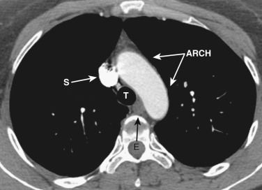 FIG 38-3, Axial plane—aortic arch level. The superior vena cava (S) and aortic arch (ARCH) lie anterior to the trachea (T) and esophagus (E). The thymus, which has undergone fatty infiltration, is anterior to the arch.