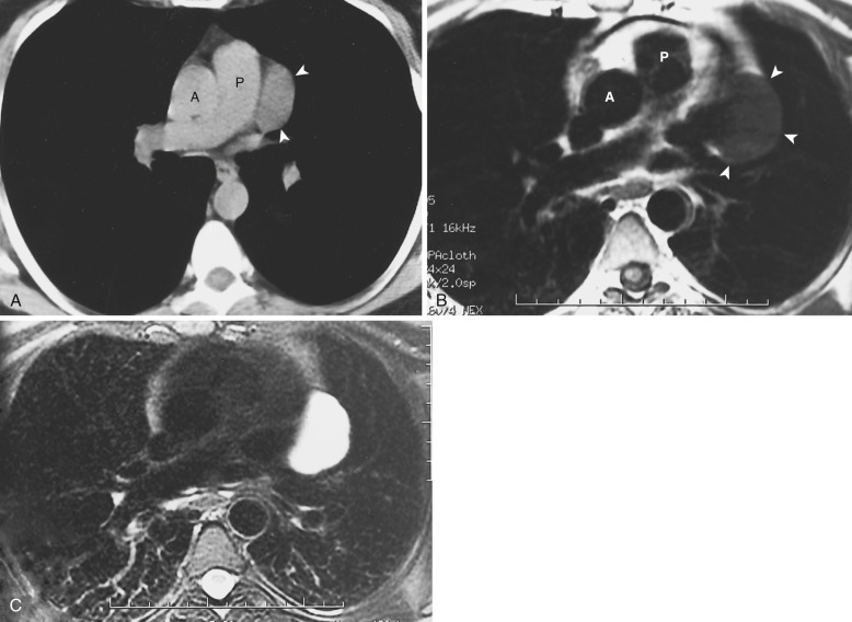 FIG 38-31, Mediastinal cyst. A, CT shows a well-circumscribed homogeneous mass in the anterior mediastinum (arrowheads). Although of lower attenuation than vascular structures, the appearance is not diagnostic for mediastinal cyst. A, ascending aorta; P, main pulmonary artery. B and C, Axial T1- and T2-weighted MRIs show the mass to be of homogeneous low signal intensity on the T1-weighted image ( arrowheads in B ) and high signal intensity on the T2-weighted image ( C ), consistent with a cyst.