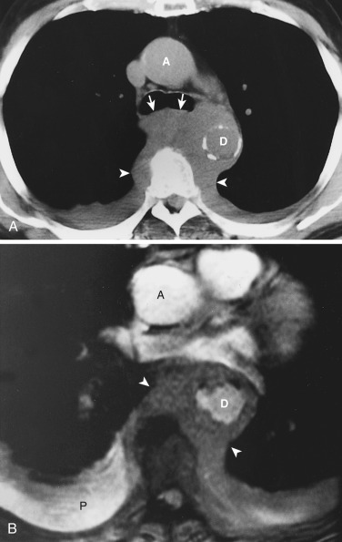 FIG 38-32, Non-Hodgkin's lymphoma in a patient with renal insufficiency. A, CT shows a homogeneous middle and posterior mediastinal mass encasing the descending aorta (D), anteriorly displacing the tracheal carina (arrows) and extending into the paravertebral region bilaterally (arrowheads). Note small bilateral pleural effusions. A, ascending aorta. B, Cine gradient-recalled echo MRI performed to evaluate possible vascular invasion confirms flow within the descending aorta (D). Note the low-signal-intensity mass (arrowheads) and the high-signal-intensity pleural effusion (P). A, ascending aorta.