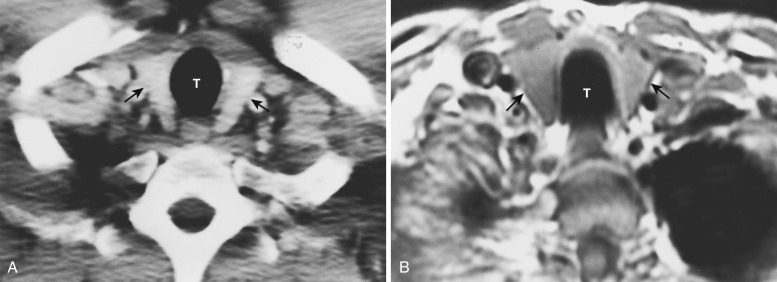 FIG 38-33, Normal thyroid gland. A, Contrast CT shows the typical appearance of the thyroid gland (arrows). Note the homogeneous enhancement. T, trachea. B, T1-weighted axial MRI shows homogeneous intermediate signal intensity, typical of a normal thyroid gland (arrows). T, trachea.
