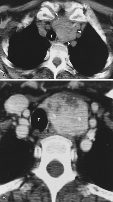 FIG 38-34, Thyroid goiter. A, CT shows a heterogeneous superior mediastinal mass (arrowheads) with punctate calcification. Images at the thoracic inlet (not shown) confirmed the mass's contiguity with the left thyroid lobe, consistent with an intrathoracic extension of goiter. T, trachea. B, Contrast CT shows heterogeneous enhancement of the mass. T, trachea.