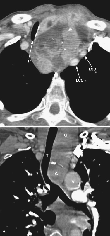 FIG 38-35, Mediastinal goiter. A, Contrast CT in the axial plane shows a large goiter (G) displacing the trachea (T) to the right and displacing the left common carotid (LCC) and left subclavian arteries (LSC) to the left. Note the heterogeneous enhancement and calcification. B, In a different patient, contrast CT in the coronal plane shows intrathoracic extension of a goiter (G) and rightward displacement of the trachea (T). Note heterogeneous enhancement and calcification. A, aorta.