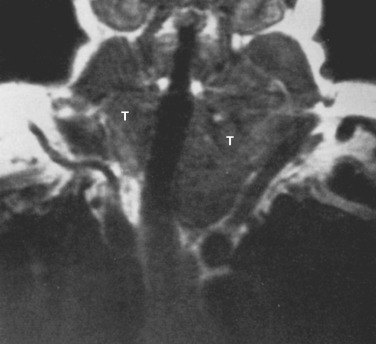 FIG 38-36, Mediastinal goiter. Coronal MRI shows mediastinal thyroid tissue (T) on both sides of the trachea. The trachea is deviated to the right at the thoracic inlet.