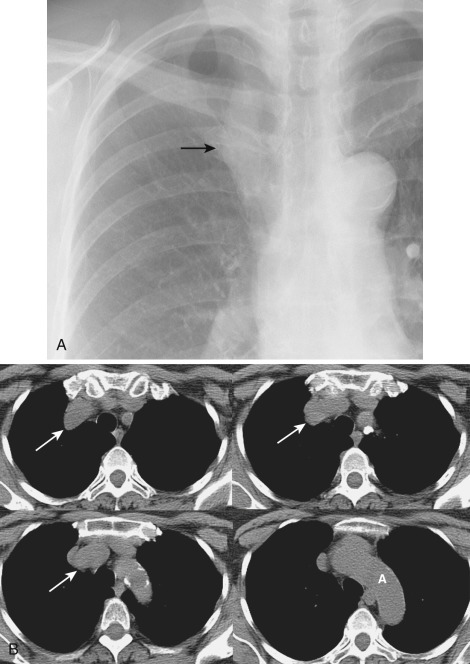 FIG 38-37, Tortuous great vessels. A, Cone view from a posteroanterior chest radiograph shows a masslike opacity along the right superior mediastinum (arrow). B, Noncontrast CT shows tortuous right brachiocephalic and subclavian arteries (arrows) causing a right paratracheal mass. A, aorta.