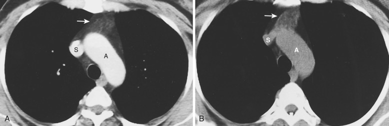 FIG 38-38, Thymus gland in a 42-year-old woman with breast carcinoma. A, Contrast CT shows fatty replacement of the thymus gland. Residual thymic tissue manifests as linear areas of soft tissue in anterior mediastinal fat (arrow). A, aorta; S, superior vena cava. B, Noncontrast CT 6 months after bone marrow transplantation shows increased soft tissue in the anterior mediastinum, consistent with thymic hyperplasia (arrow). A, aorta; S, superior vena cava.