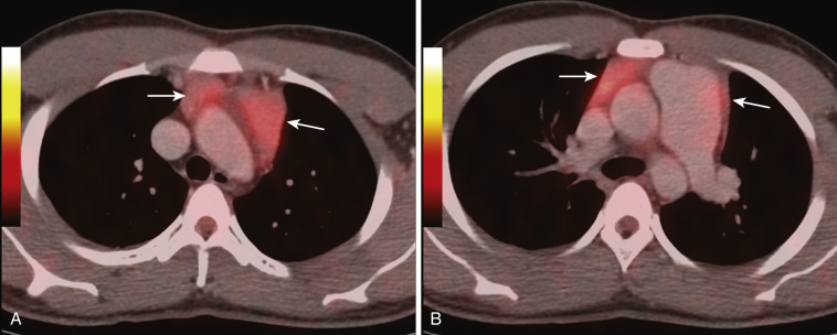 FIG 38-39, Normal thymus in a 20-year-old man. A and B, Contrast-enhanced PET/CT shows soft tissue (arrows) in the anterior mediastinum that conforms to the normal shape of the thymus gland. Note homogeneous FDG uptake in normal thymic tissue.