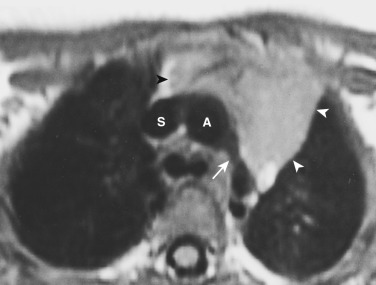 FIG 38-40, Normal thymus in a 9-month-old child with coarctation of the aorta. Axial T1-weighted MRI shows the thymus gland (arrowheads) in the mediastinum, anterior to the aorta (A), with homogeneous intermediate signal intensity less than that of fat. Note the aortic coarctation (arrow). S, superior vena cava.